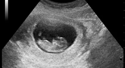 Ultrasound image of early pregnancy 