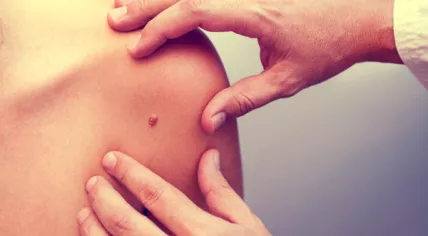 Mole check