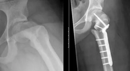 Amsterdam hospital OLVG used a 3D printed titanium plate to correct the hip of a 13-year-old girl, June 2017