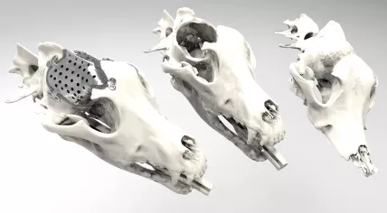 Left to right: skull roof prosthesis, skull after removing tumor, skull with tumor