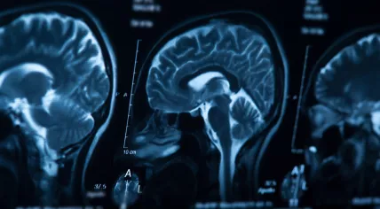 CT scan of a brain