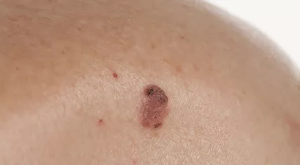 Skin blemish