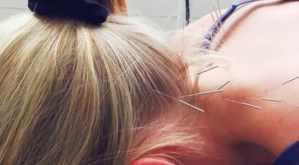 Acupuncture 