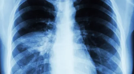 Chest x-ray of a patient presenting with pneumonia. The x-ray shows alveolar infiltrate in the middle lobe of the right lung.