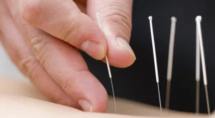 Acupuncture