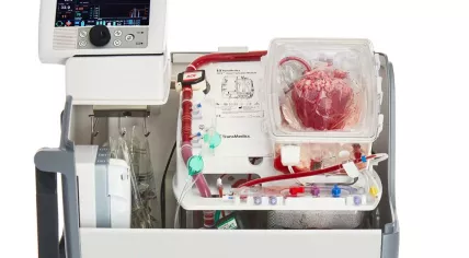 Transmedics Organ Care System, or "Heart in a Box", in use in the Netherlands since April 2021