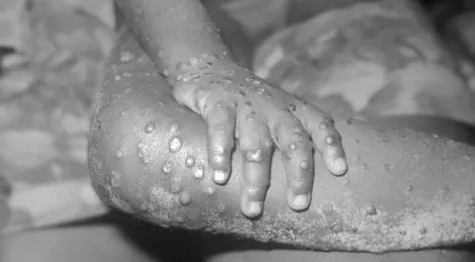 Close-up of monkeypox lesions on the arm and leg of a female child