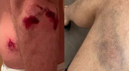 Injuries Aaron E. sustained in a homophobic assault on Rozengracht in Amsterdam, 17 July 2022