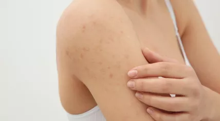 Woman scratching a rash