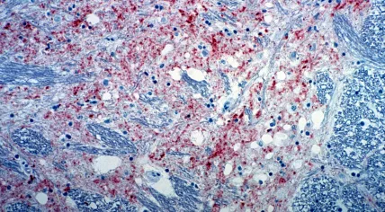 A section of brain from a cow infected with bovine spongiform encephalopathy showing spongy tissue with microscopic holes. September 2000