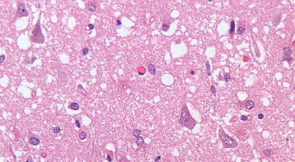 Photo taken with a light microscope showing spongiform degeneration, the holes or vacuoles in the cerebral cortex of a patient who had died of Creutzfeldt-Jakob disease. June 2022