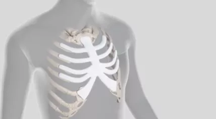 Sternum and partial ribs prosthesis implanted on a 47-year-old woman from Emmen by the UMC Groningen in January 2023
