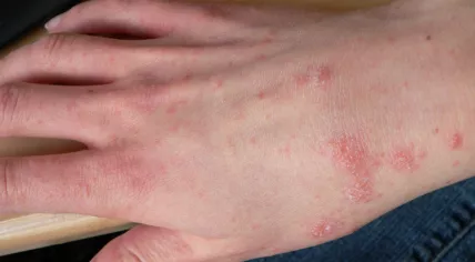 Scabies