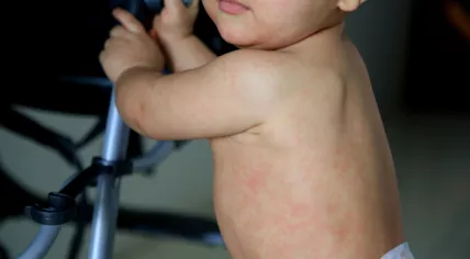 A small child with a measles rash