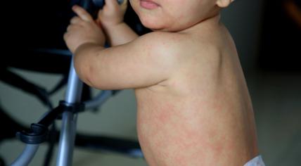 A young child with a measles rash