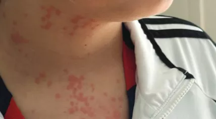 An American family alleged a bed bug infestation of their business class seats on a KLM flight from Atlanta to Amsterdam caused serious discomfort and skin complaints. This photo claiming to show the rash caused by bed bugs on the flight was submitted as part of a lawsuit. Mar. 21, 2025