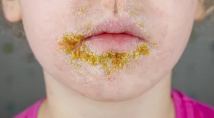 A child with impetigo around the month.