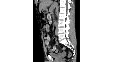 CT scan of man caught with 75 packages of drugs in his body in Cologne, February 2026