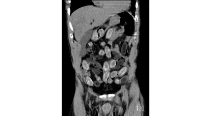 CT scan of man caught with 75 packages of drugs in his body in Cologne, February 2026