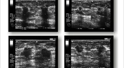 800px-Breastcancer_ultrasound