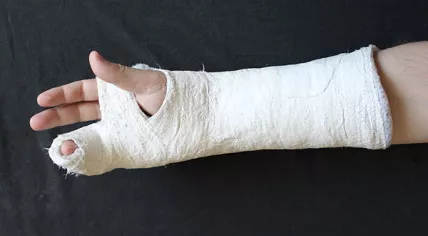 400px-Hand_in_gips_(Fifth_Metacarpal_Fracture)_3