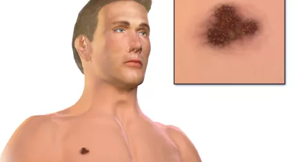 Blausen_0633_Melanoma