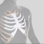 Sternum and partial ribs prosthesis implanted on a 47-year-old woman from Emmen by the UMC Groningen in January 2023