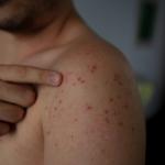 A man has measles.