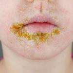 A child with impetigo around the month.