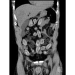 CT scan of man caught with 75 packages of drugs in his body in Cologne, February 2026